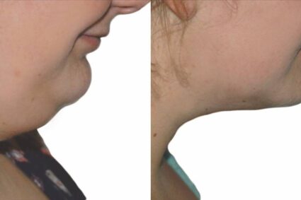 Strawberry Laser: L’Arme Secrète des Célébrités pour un Corps Parfait