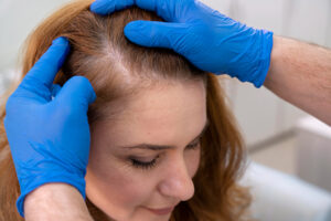 greffe de cheveux pour les femmes